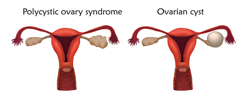 PCOS symptoms and treatments: PART 2 - Eve Health